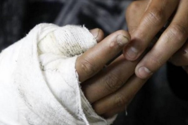 Reportan en Neiva primer lesionado por pólvora