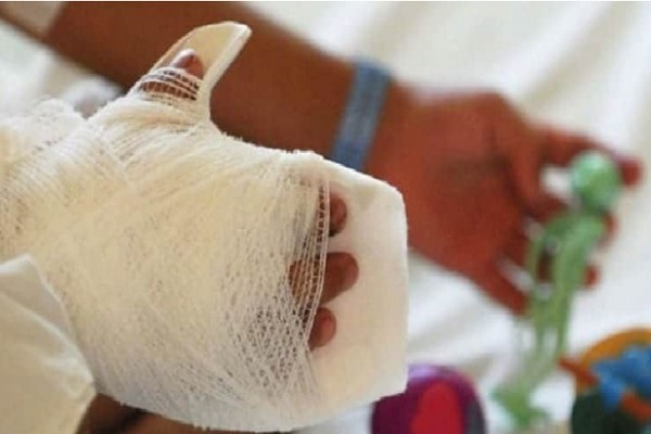 Sexto quemado con pólvora en el Huila se registró en Pitalito