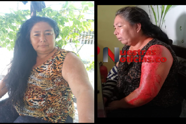 Mujer atacada con ácido teme ser una víctima más del feminicidio