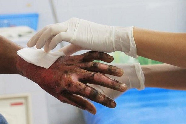 Aumentó el número de quemados con pólvora en el Huila